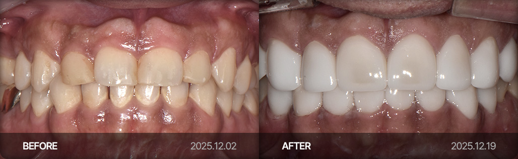 라미네이트 치료 사례