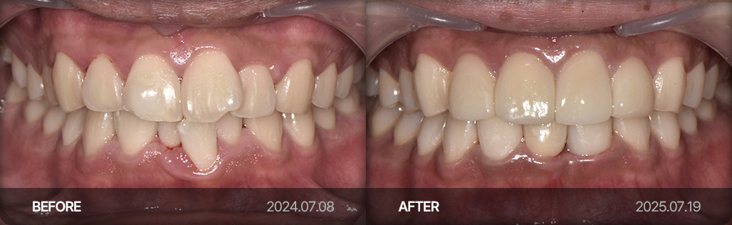 라미네이트 치료 사례