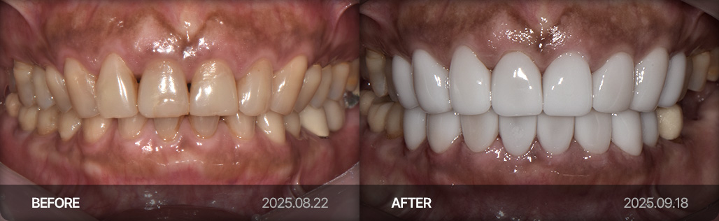 라미네이트 치료 사례