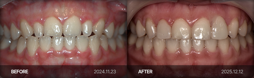 라미네이트 치료 사례