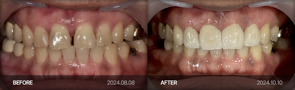 라미네이트 치료 사례