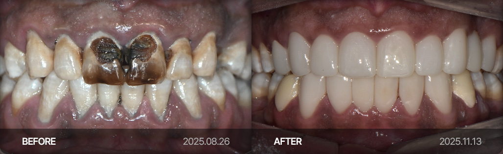 라미네이트 치료 사례