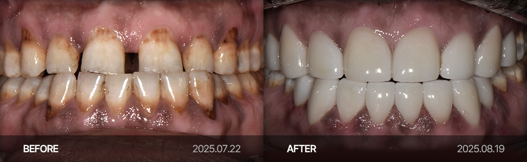 라미네이트 치료 사례