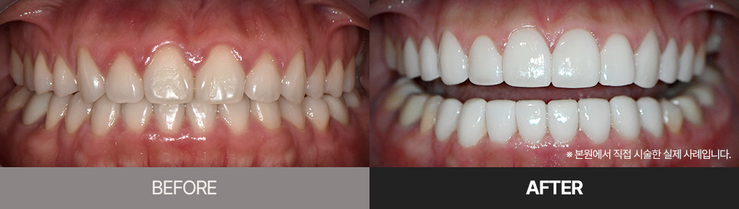 라미네이트 전후 사례